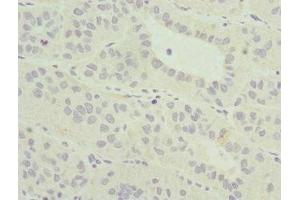 Immunohistochemistry of paraffin-embedded human liver cancer using ABIN7165022 at dilution of 1:100 (AF9 anticorps  (AA 1-150))