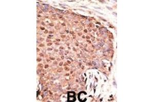 Formalin-fixed and paraffin-embedded human cancer tissue reacted with the primary antibody, which was peroxidase-conjugated to the secondary antibody, followed by AEC staining.