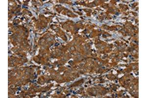 The image on the left is immunohistochemistry of paraffin-embedded Human breast cancer tissue using ABIN7191878(PIK3CD Antibody) at dilution 1/20, on the right is treated with synthetic peptide. (PIK3CD anticorps)