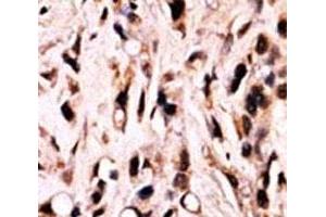 IHC analysis of FFPE breast carcinoma stained with phospho-SMAD4 antibody. (SMAD4 anticorps  (pThr277))