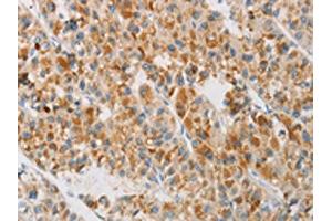 The image on the left is immunohistochemistry of paraffin-embedded Human liver cancer tissue using ABIN7130419(NGB Antibody) at dilution 1/20, on the right is treated with fusion protein. (Neuroglobin anticorps)