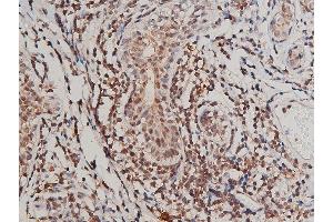 ABIN6267415 at 1/200 staining human breast cancer tissue sections by IHC-P.