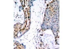 Immunohistochemistry of paraffin-embedded Human breast carcinoma using Phospho-Estrogen Receptor alpha(S118) Polyclonal Antibody (Estrogen Receptor alpha anticorps  (pSer118))