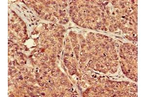 Immunohistochemistry of paraffin-embedded human ovarian cancer using ABIN7164854 at dilution of 1:100 (PTGER3 anticorps  (AA 1-49))