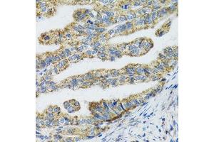 Immunohistochemistry of paraffin-embedded human gastric cancer using TXN2 antibody.