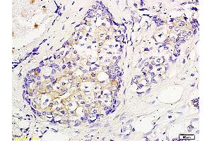Formalin-fixed and paraffin embedded human breast cancer labeled with Anti CEP55 Polyclonal Antibody, Unconjugated (ABIN872963) followed by conjugation to the secondary antibody and DAB staining (CEP55 anticorps  (AA 151-250))