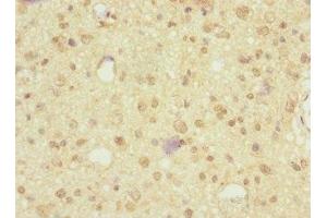 Immunohistochemistry of paraffin-embedded human glioma using ABIN7161221 at dilution of 1:100 (Neurexin 3 anticorps  (AA 1584-1643))