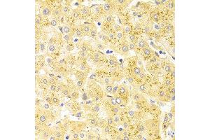 Immunohistochemistry of paraffin-embedded human liver injury using WT1 antibody at dilution of 1:100 (x400 lens). (WT1 anticorps)