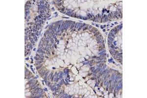 Immunohistochemistry of paraffin-embedded human rectal cancer using NPPA antibody at dilution of 1:200 (x400 lens). (NPPA anticorps  (AA 26-151))