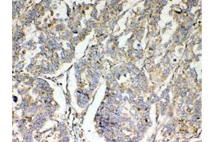 IHC testing of FFPE human lung cancer tissue with TSPAN12 antibody at 1ug/ml. (TSPAN12 anticorps)