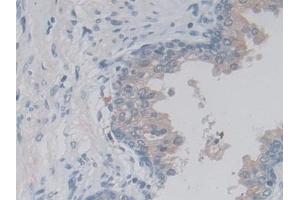 Detection of LACTb in Human Prostate Tissue using Polyclonal Antibody to Lactamase Beta (LACTb)