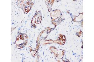Anti-Kallikrein 2 antibody, IHC(P) IHC(P): Human Prostatic Cancer Tissue