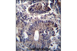 ZFYVE19 Antibody (C-term) (ABIN656951 and ABIN2846138) immunohistochemistry analysis in formalin fixed and paraffin embedded human colon carcinoma followed by peroxidase conjugation of the secondary antibody and DAB staining. (ZFYVE19 anticorps  (C-Term))