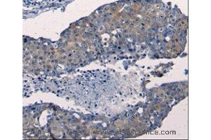 Immunohistochemistry of Human breast cancer using FGF2 Polyclonal Antibody at dilution of 1:50 (FGF2 anticorps)