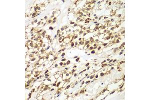 Immunohistochemistry of paraffin-embedded human kidney cancer using SMAD9 antibody (ABIN5975592) at dilution of 1/100 (40x lens). (SMAD9 anticorps)