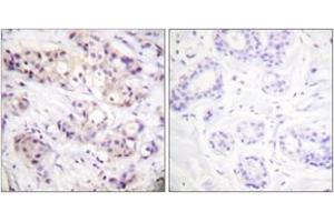 Immunohistochemistry analysis of paraffin-embedded human breast carcinoma tissue, using PKC alpha (Ab-638) Antibody. (PKC alpha anticorps  (AA 606-655))