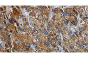 Immunohistochemistry of paraffin-embedded Human liver cancer using PDSS2 Polyclonal Antibody at dilution of 1:30 (PDSS2 anticorps)