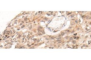 Immunohistochemistry of paraffin-embedded Human esophagus cancer tissue using KNOP1 Polyclonal Antibody at dilution of 1:85(x200) (KNOP1 anticorps)