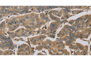Immunohistochemistry of paraffin-embedded Human breast cancer tissue using TBXAS1 Polyclonal Antibody at dilution 1:30 (TBXAS1 anticorps)