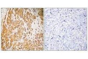 Immunohistochemistry analysis of paraffin-embedded human breast carcinoma tissue, using ZSCAN22 antibody. (ZSCAN22 anticorps)