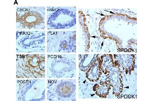 SPOCK1 was a TGF-β-induced myoepithelial marker and SPOCK1 overexpression enhanced invasiveness.