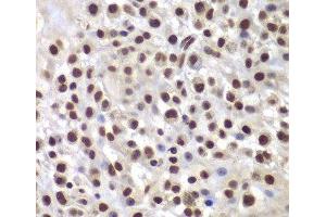 Immunohistochemistry of paraffin-embedded Mouse osteosarcoma using SMARCB1 Polyclonal Antibody at dilution of 1:200 (40x lens).