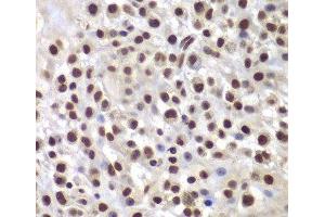 Immunohistochemistry of paraffin-embedded Mouse osteosarcoma using SMARCB1 Polyclonal Antibody at dilution of 1:200 (40x lens). (SMARCB1 anticorps)