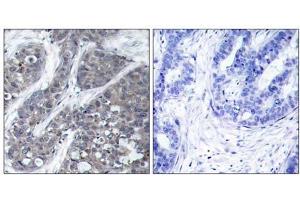 Immunohistochemical analysis of paraffin-embedded human breast carcinoma tissue, using Pyk2 (Ab-402) antibody (E021209). (PTK2B anticorps)