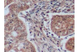 Detection of Ki-67 in Human Endometrial cancer Tissue using Polyclonal Antibody to Ki-67 Protein (Ki-67) (Ki-67 anticorps  (AA 2815-2928))