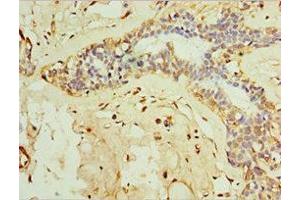 Immunohistochemistry of paraffin-embedded human breast cancer using ABIN7156612 at dilution of 1:100 (IL28B anticorps  (AA 22-196))