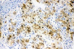 IHC analysis of ADH1A using anti- ADH1A antibody .