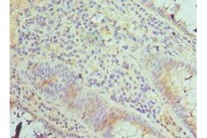 Immunohistochemistry of paraffin-embedded human colon cancer using ABIN7171965 at dilution of 1:100