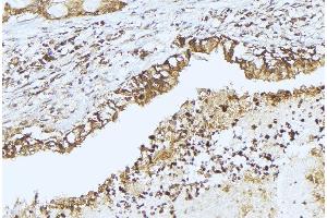 ABIN6275349 at 1/100 staining Human lung cancer tissue by IHC-P. (PEX14 anticorps  (Internal Region))