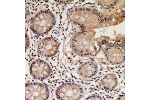 Immunohistochemical analysis of STEAP2 staining in human colon cancer formalin fixed paraffin embedded tissue section. (STEAP2 anticorps  (C-Term))