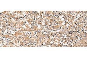 Immunohistochemistry of paraffin-embedded Human liver cancer tissue using LEPR Polyclonal Antibody at dilution of 1:30(x200) (Leptin Receptor anticorps)