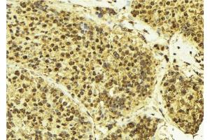 ABIN6276492 at 1/100 staining Human breast cancer tissue by IHC-P. (Cullin 3 anticorps  (Internal Region))