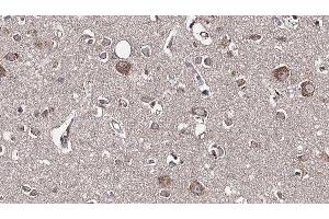 ABIN6277595 at 1/100 staining Human brain cancer tissue by IHC-P. (GDI1 anticorps  (Internal Region))