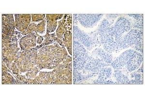 Immunohistochemistry analysis of paraffin-embedded human liver carcinoma tissue, using CYP8B1 antibody. (CYP8B1 anticorps  (Internal Region))
