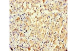 Immunohistochemistry of paraffin-embedded human lung cancer using ABIN7166679 at dilution of 1:100 (BPESC1 anticorps  (AA 1-116))