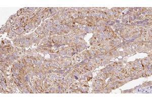 ABIN6273304 at 1/100 staining Human thyroid cancer tissue by IHC-P.