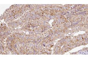 ABIN6273304 at 1/100 staining Human thyroid cancer tissue by IHC-P. (RAB14 anticorps  (C-Term))