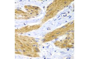 Immunohistochemistry of paraffin-embedded human gastric cancer using HRas antibody at dilution of 1:100 (40x lens). (HRAS anticorps)