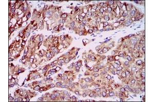 Immunohistochemical analysis of paraffin-embedded liver cancer tissues using CCL2 mouse mAb with DAB staining. (CCL2 anticorps)