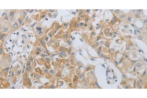 Immunohistochemistry of paraffin-embedded Human lung cancer using MMP25 Polyclonal Antibody at dilution of 1:80 (MMP25 anticorps)