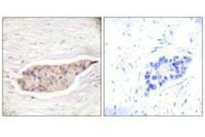 Immunohistochemical analysis of paraffin-embedded human breast carcinoma tissue using Annexin A6 antibody. (ANXA6 anticorps)