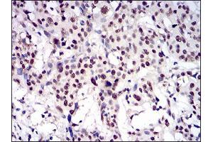 Immunohistochemical analysis of paraffin-embedded esophageal cancer tissues using CTNNBL1 mouse mAb with DAB staining.