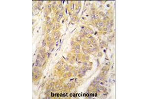 Formalin-fixed and paraffin-embedded human breast carcinoma tissue reacted with PKM2 polyclonal antibody  , which was peroxidase-conjugated to the secondary antibody, followed by DAB staining . (PKM2 anticorps  (AA 483-513))
