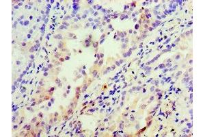 Immunohistochemistry of paraffin-embedded human lung cancer using ABIN7156235 at dilution of 1:100