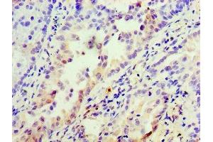 Immunohistochemistry of paraffin-embedded human lung cancer using ABIN7156235 at dilution of 1:100 (INHBA anticorps  (AA 311-426))
