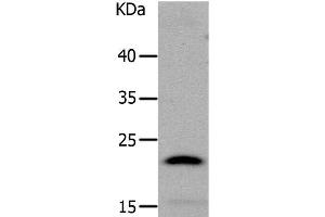 Western Blot analysis of Human liver cancer tissue using LCN2 Polyclonal Antibody at dilution of 1:1050 (Lipocalin 2 anticorps)